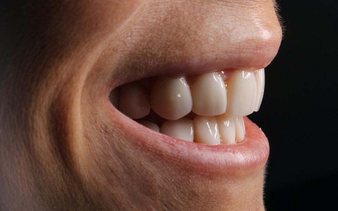 veneers before and after